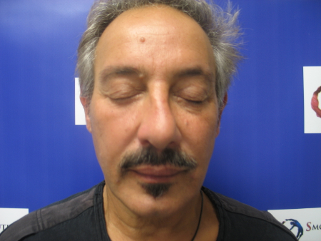 Before Image: Patient # 18077 - 