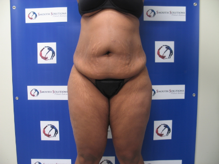 Before Image: Patient # 85656 - 
