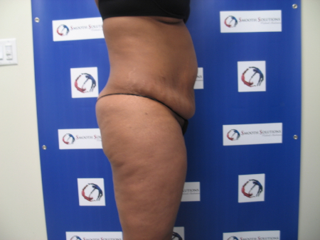 Before Image: Patient # 85656 - 