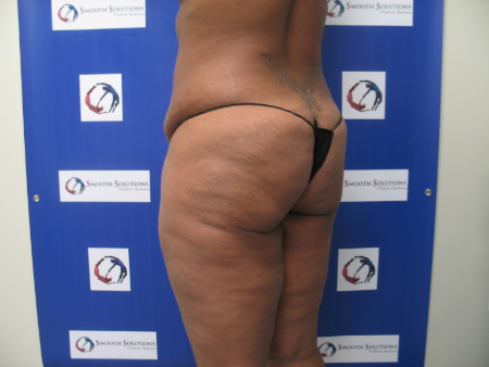 Before Image: Patient # 85656 - 