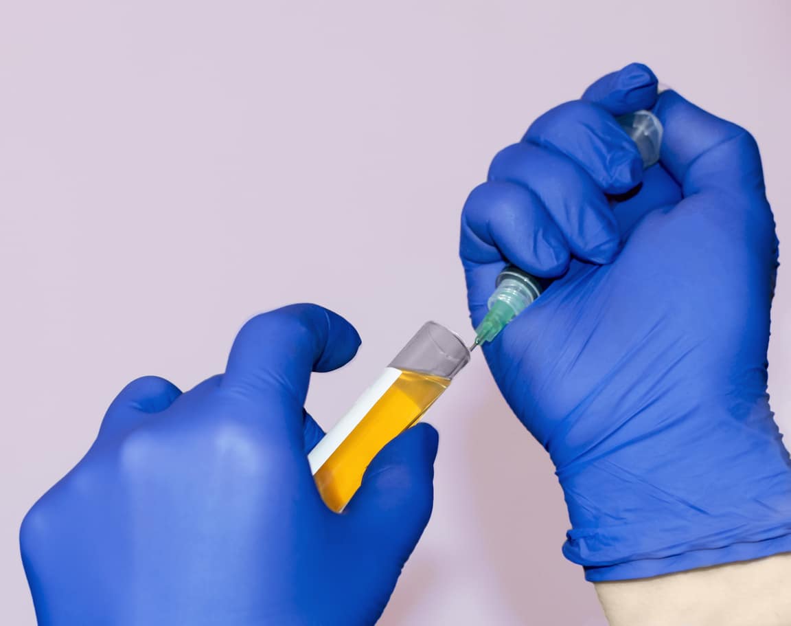 Hands in blue gloves filling blood plasma from test tube into syringe. Plasma for a P-Shot to correct erectile dysfunction. 