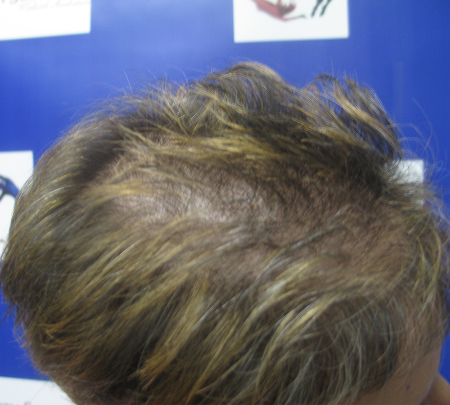 Before Image: Patient # 84645 - 