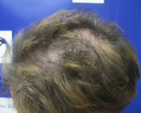 Before Image: Patient # 84645 - 