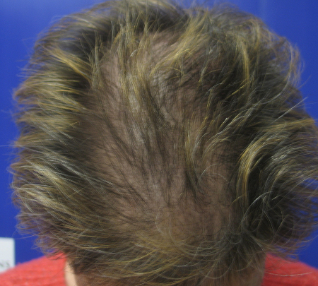 Before Image: Patient # 84645 - 