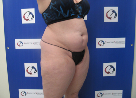 Before Image: Patient # 92369 - 