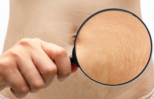 Stretch marks the abdomen through a magnifying glass.