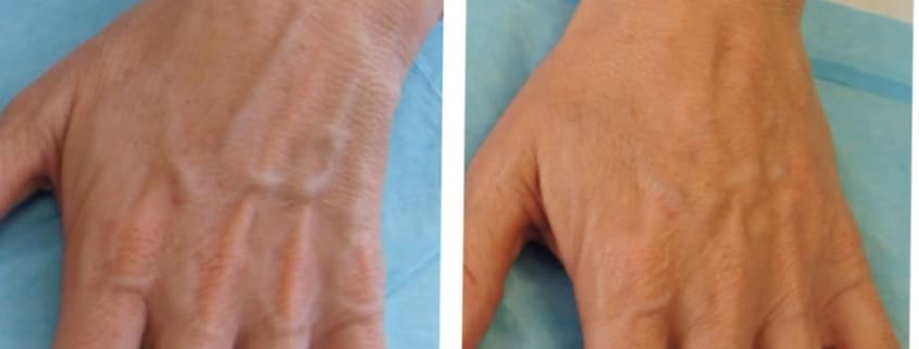 patient’s hand before and after radiesse treatment, veins less visible afterwards
