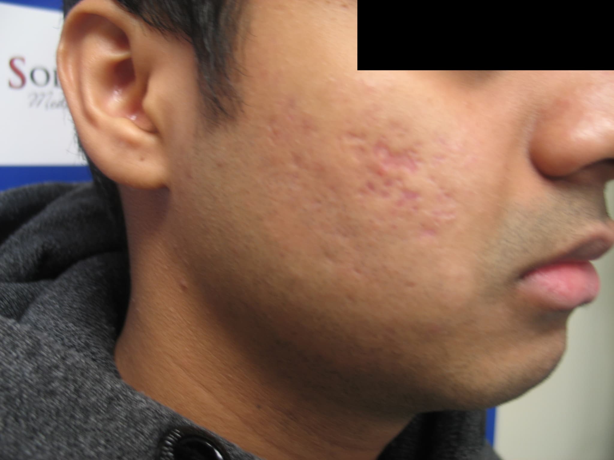 Before and after PRP Treatment Williamsville NY