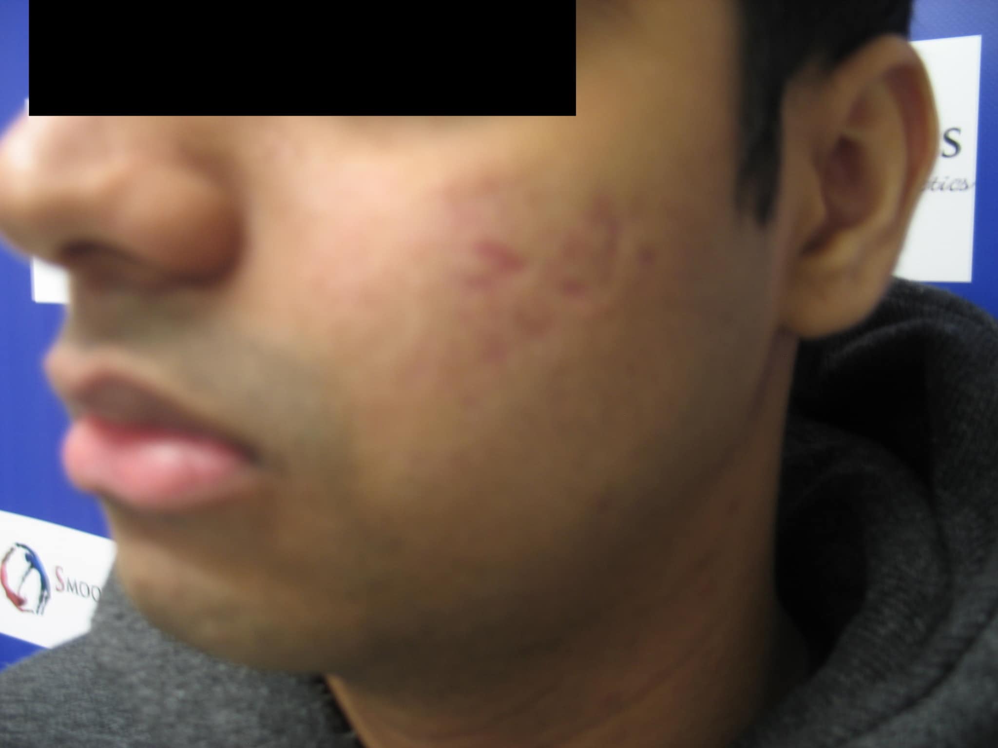 After and Before PRP Treatment Buffalo NY