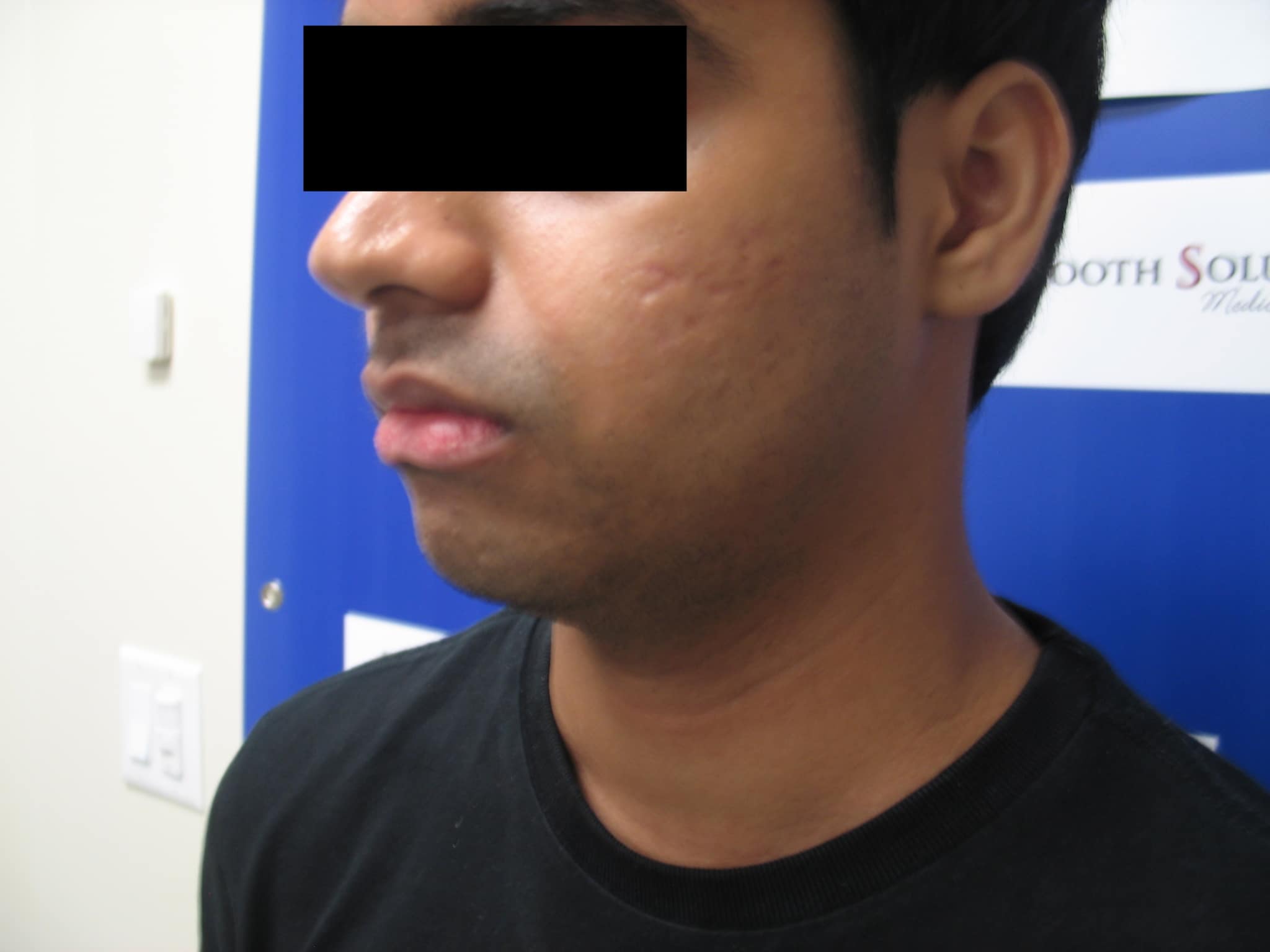 After and Before PRP Treatment Williamsville NY