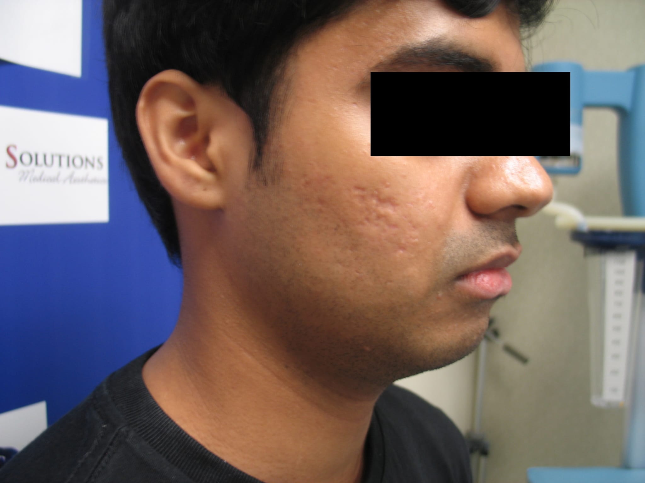 Before and after PRP Treatment Buffalo NY
