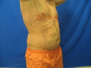 shirtless man with drawings on body before liposculpture treatment