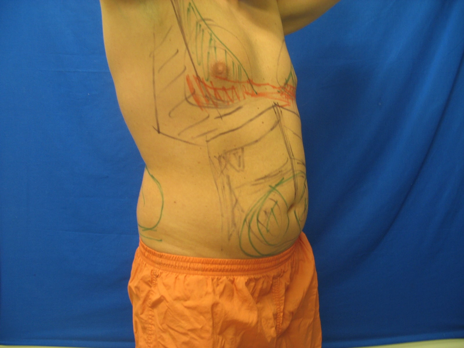 Before Liposculpture Buffalo NY