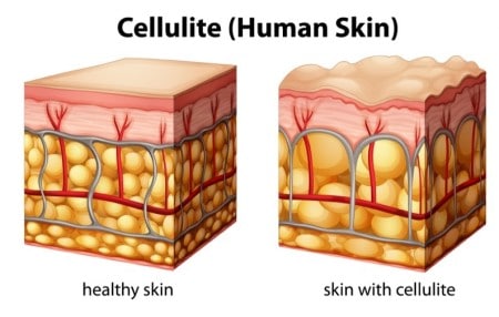 Effective Ways To Get Rid Of Cellulite Naturally & Effectively Fundamentals Explained thumbnail