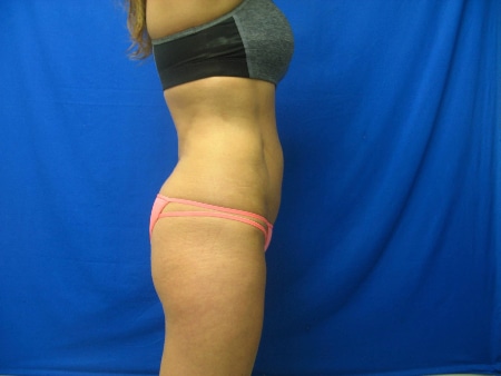 After Liposculpture Treatment Williamsville NY