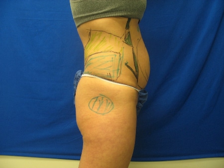 Before Liposculpture Treatment Williamsville NY
