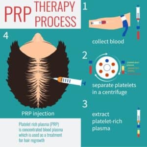 PRP Process 705x705 1