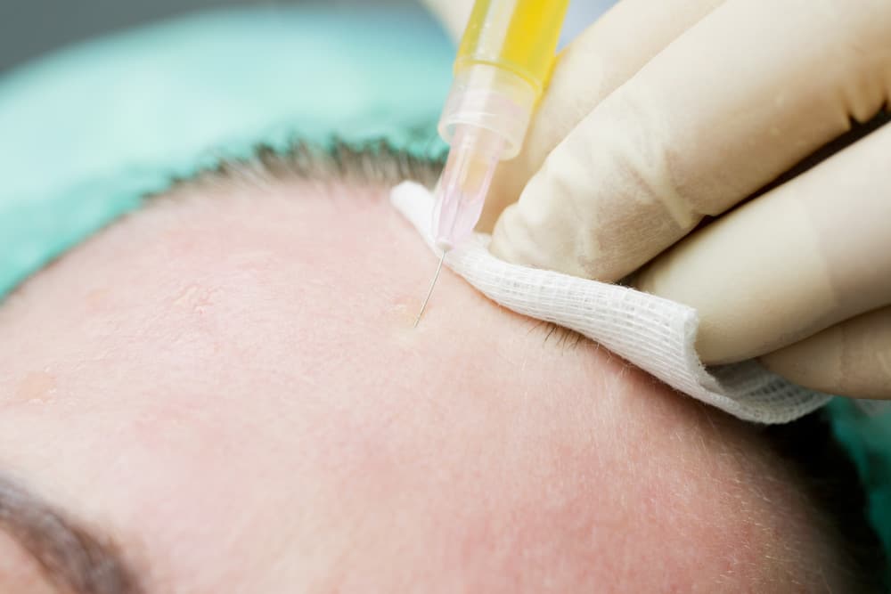 After and Before PRP Therapy Williamsville NY