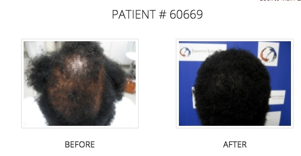 back of black male patient’s head before and after hair restoration treatment, hair much fuller and bald spot gone after treatment