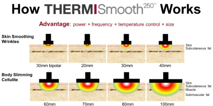 ThermiSmooth250 Penetrazione21 705x353 1