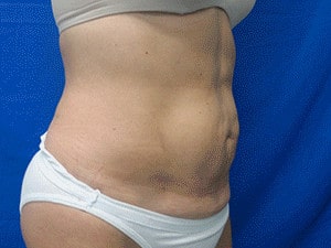 After Liposculpture Treatment Buffalo NY