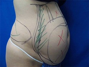Before Liposculpture Treatment Buffalo NY
