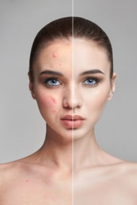 female patient before and after acne treatment