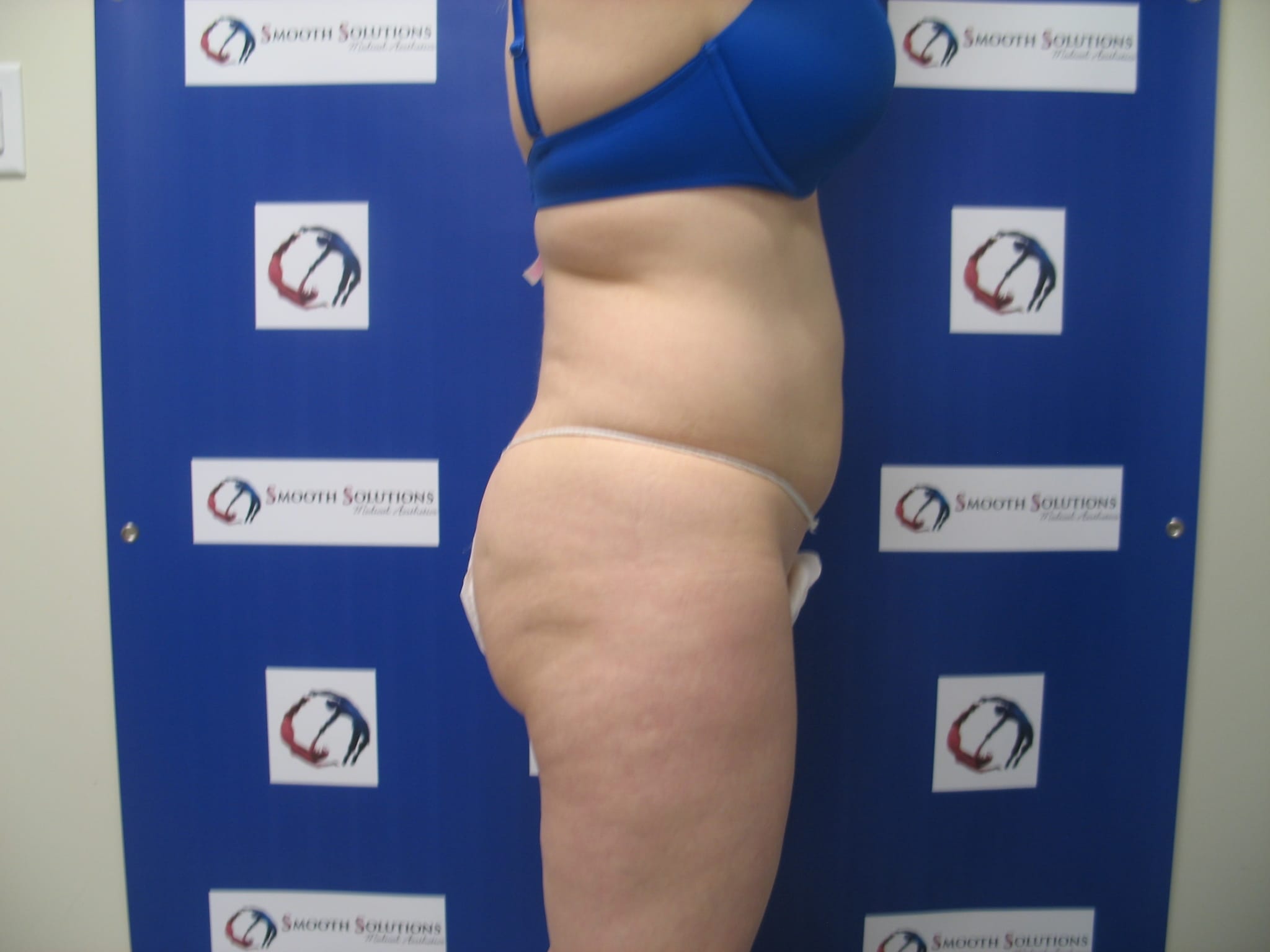 side view of woman in underwear before liposculpture treatment