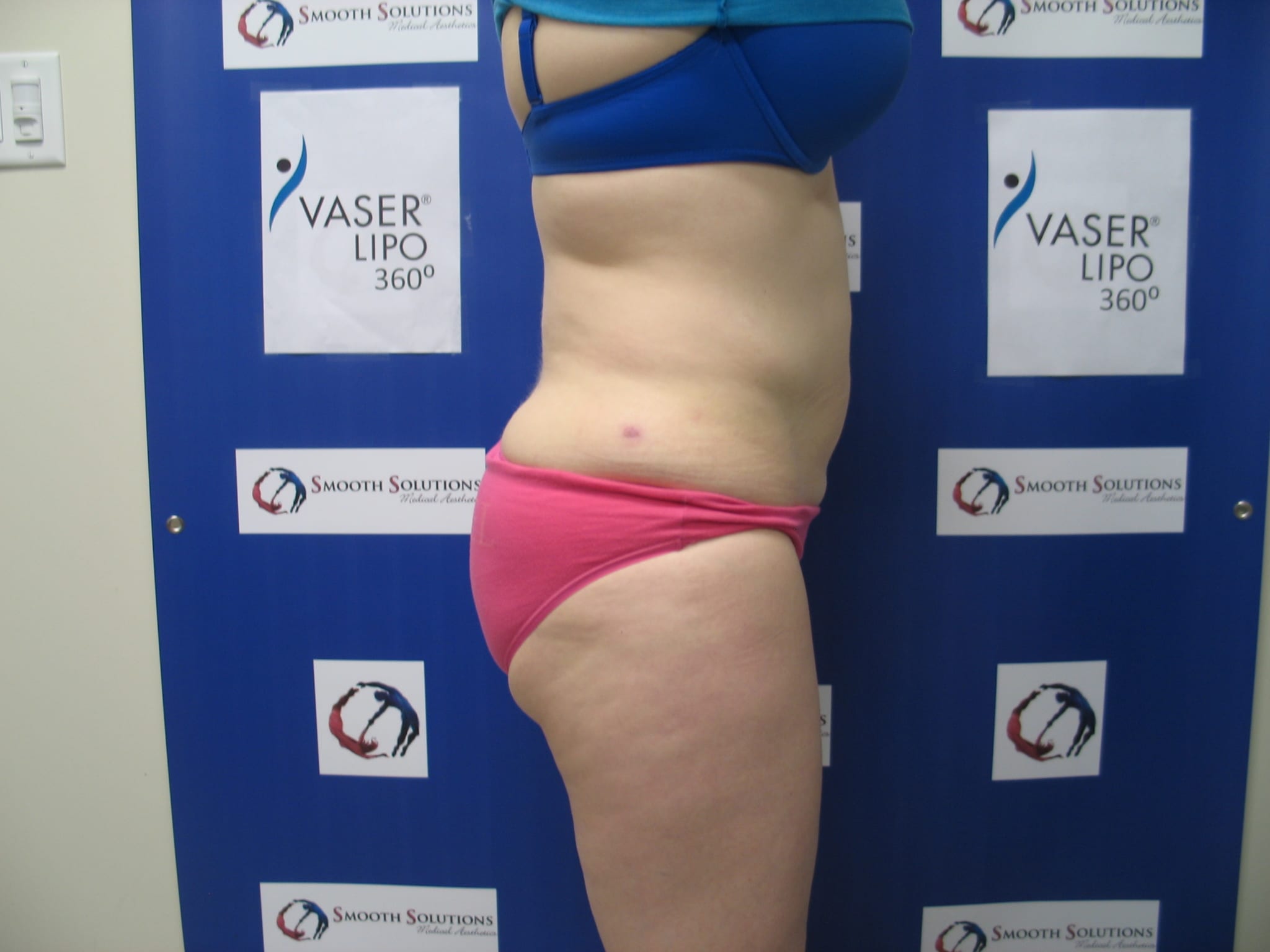 side view of woman in underwear with flatter stomach after liposculpture treatment
