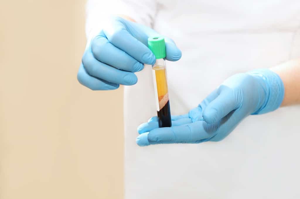 medical test tube with blood plasma in hands for prp therapy after picture id1097602720