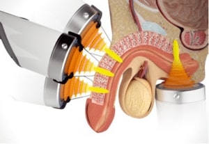 Acoustic Shockwave Therapy Buffalo NY