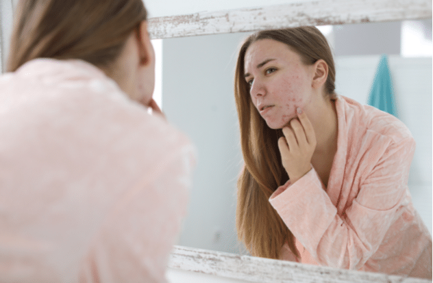 woman with acne problem near mirror in bathroom