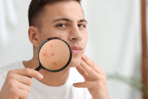 young man with acne problem and magnifier at home