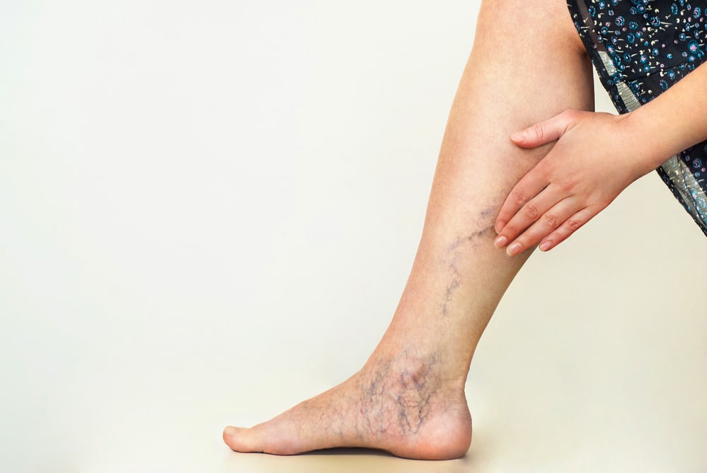 Varicose veins on the womans legs
