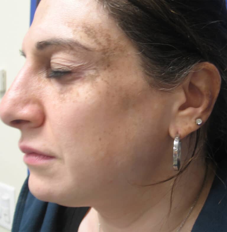 Before Image: Sylfirm - left-side