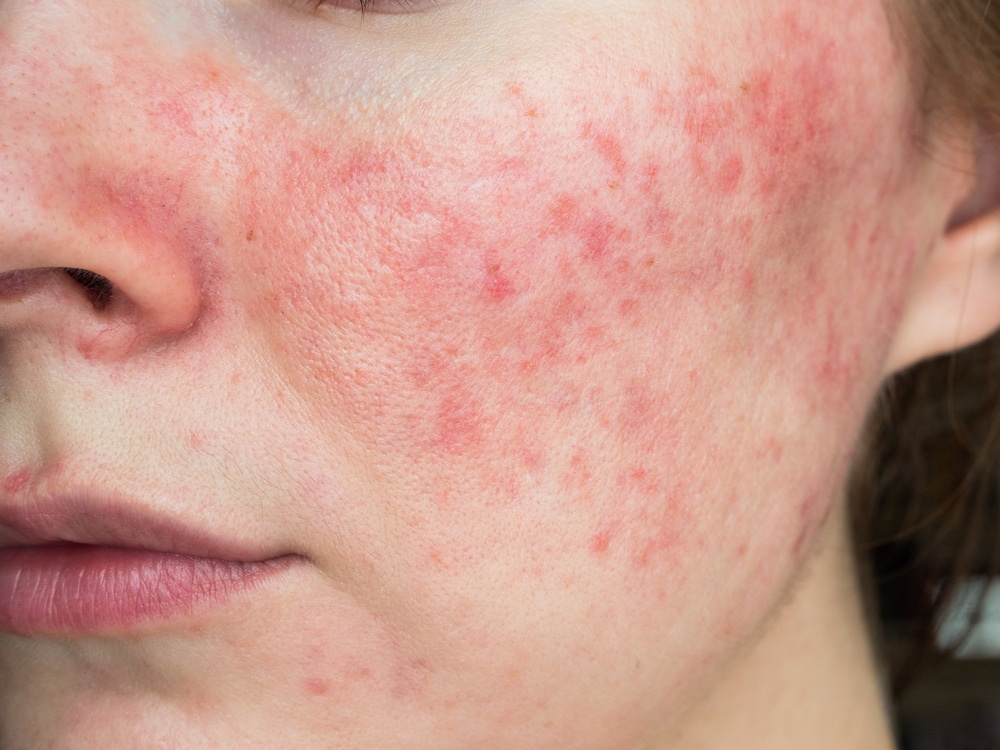 Papulopustular,Rosacea,,Close up,Of,The,Patient's,Cheek