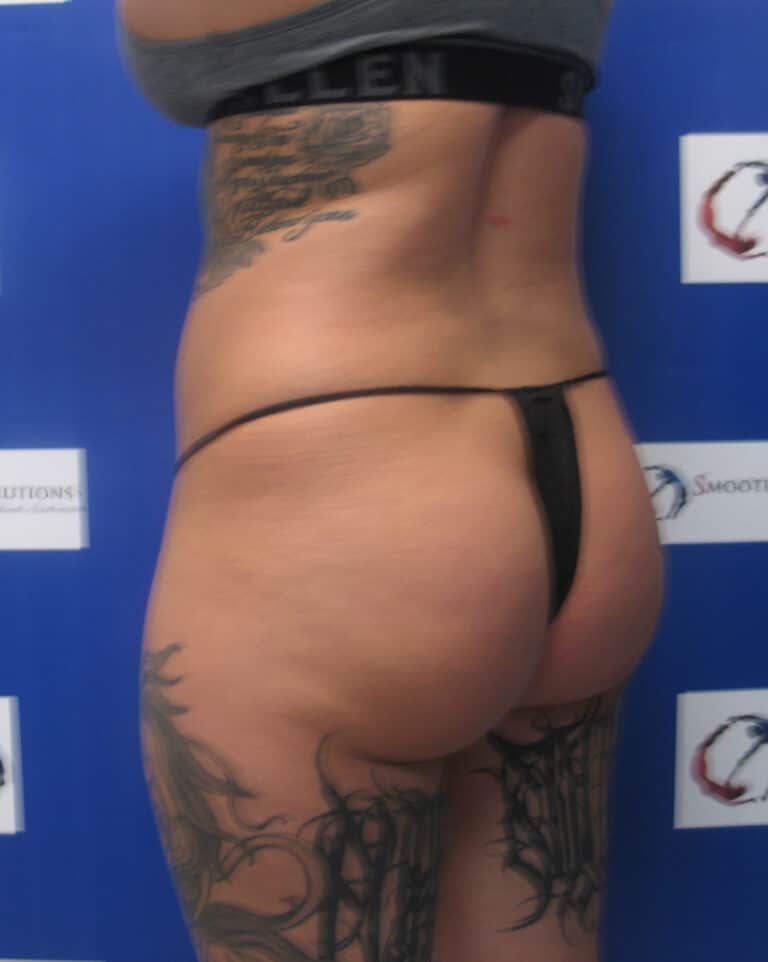 Before Image: Patient # 4706 - left-back-oblique