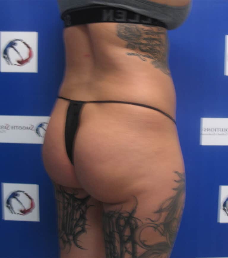 Before Image: Patient # 4706 - right-back-oblique