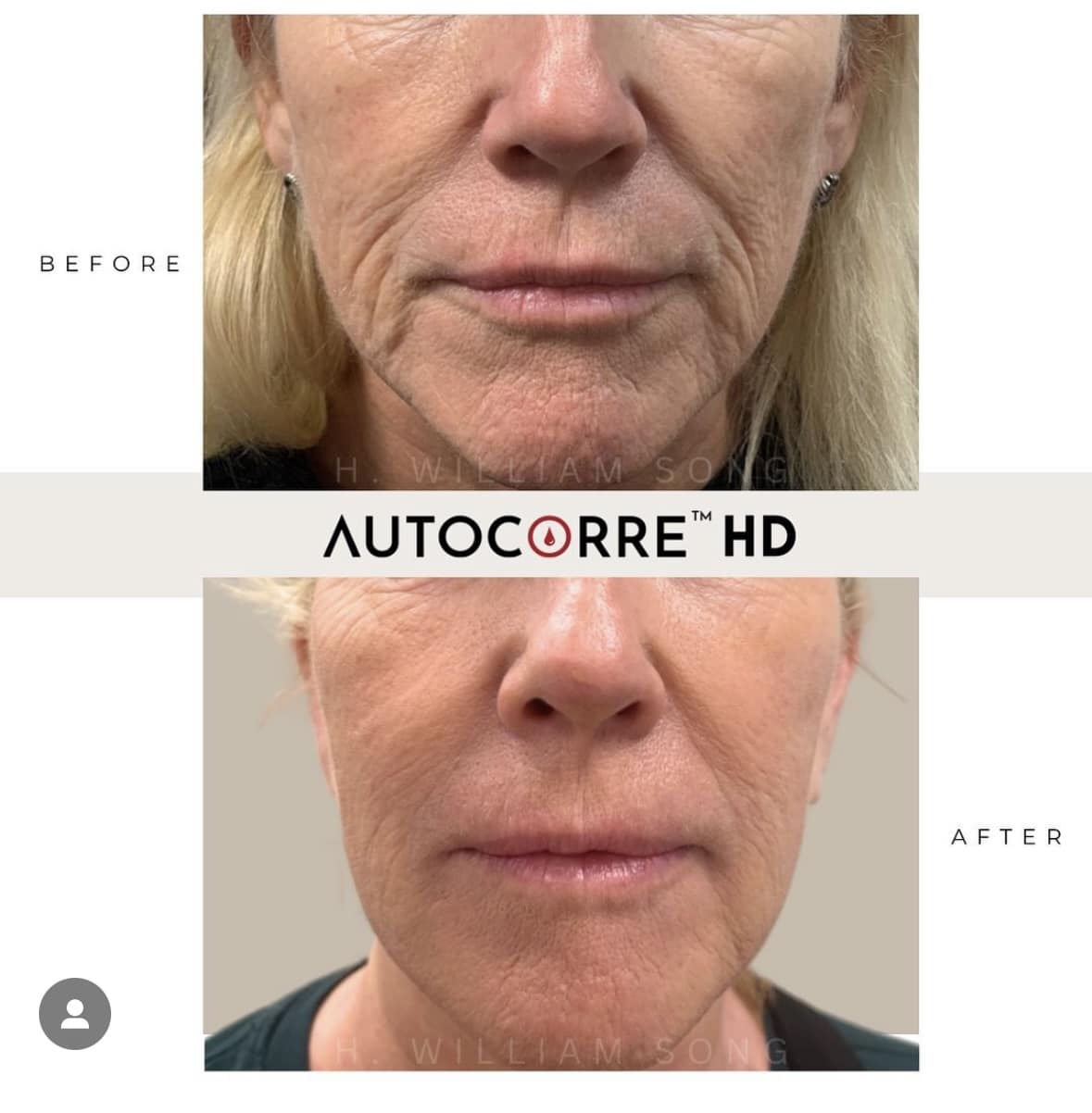Before and After Autocorre Williamsville NY