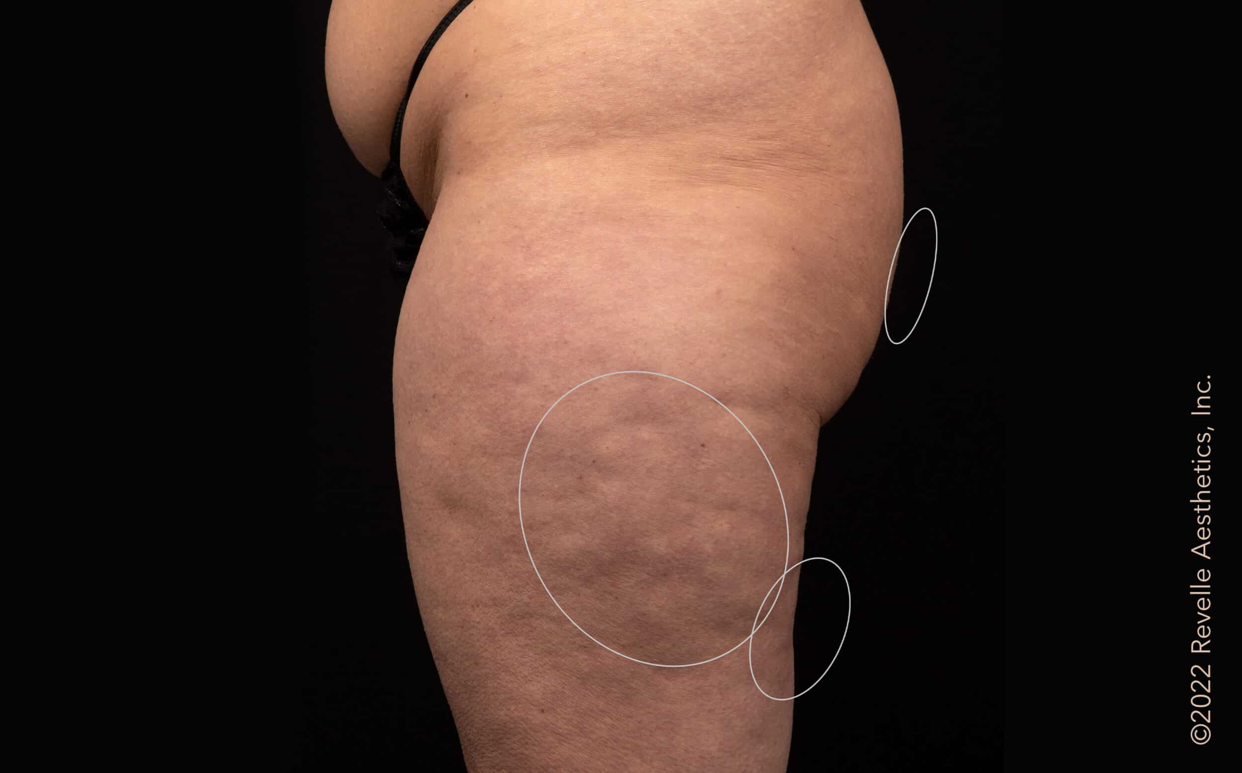 After Cellulite Treatment Williamsville NY