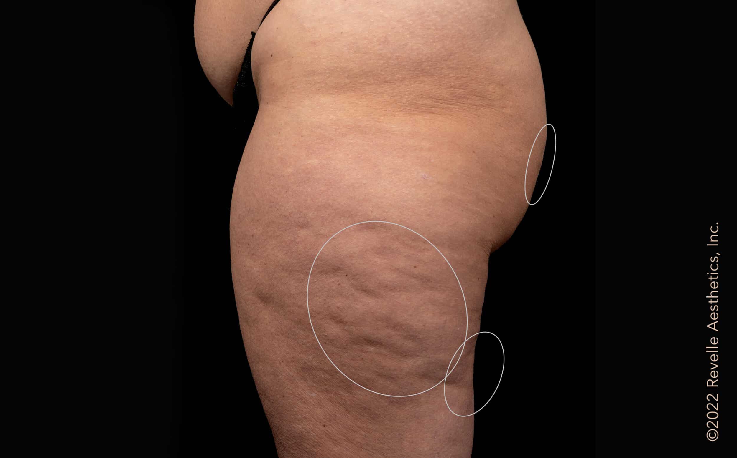 Before Cellulite Treatment Williamsville NY