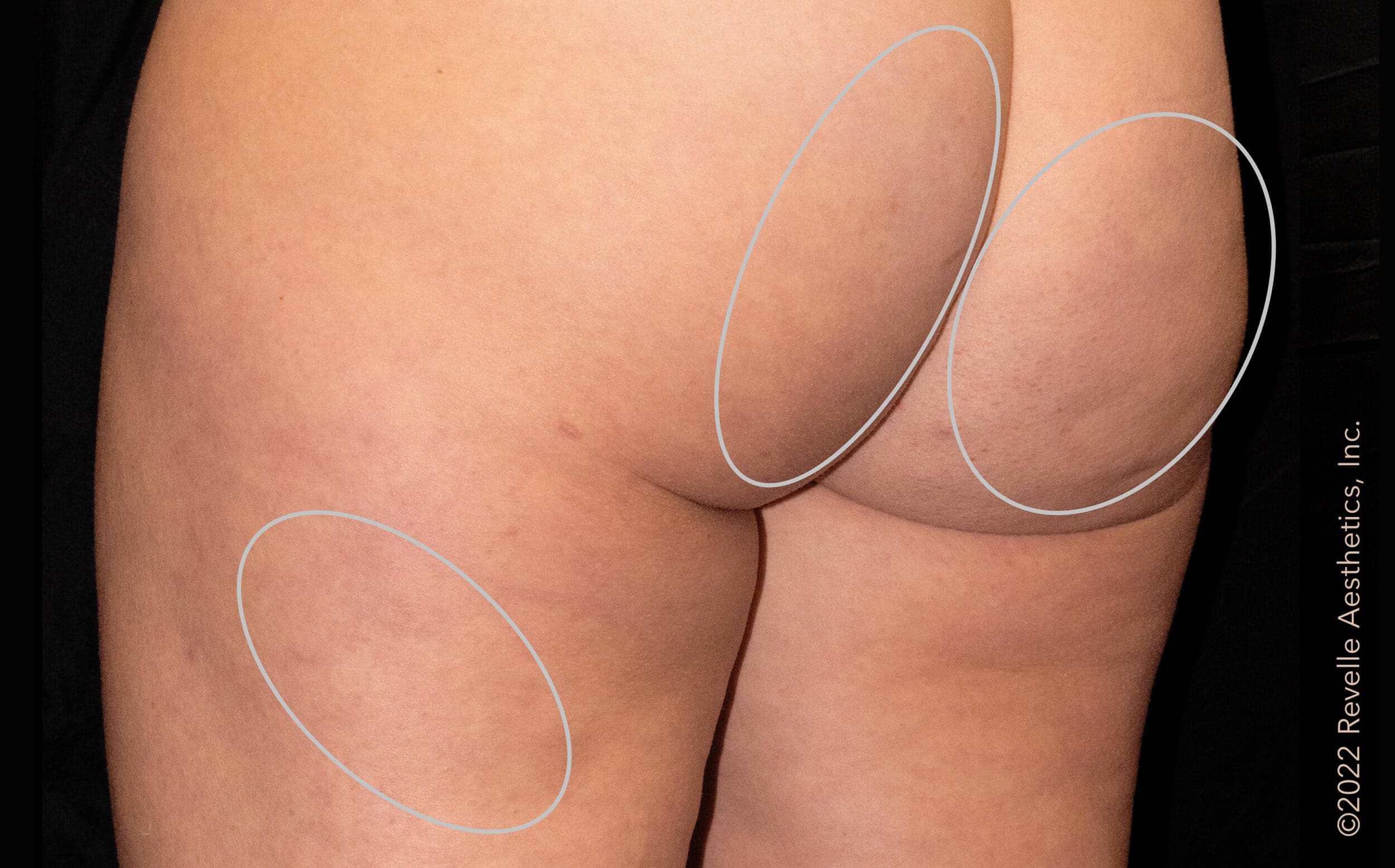 After Cellulite Treatment Williamsville NY