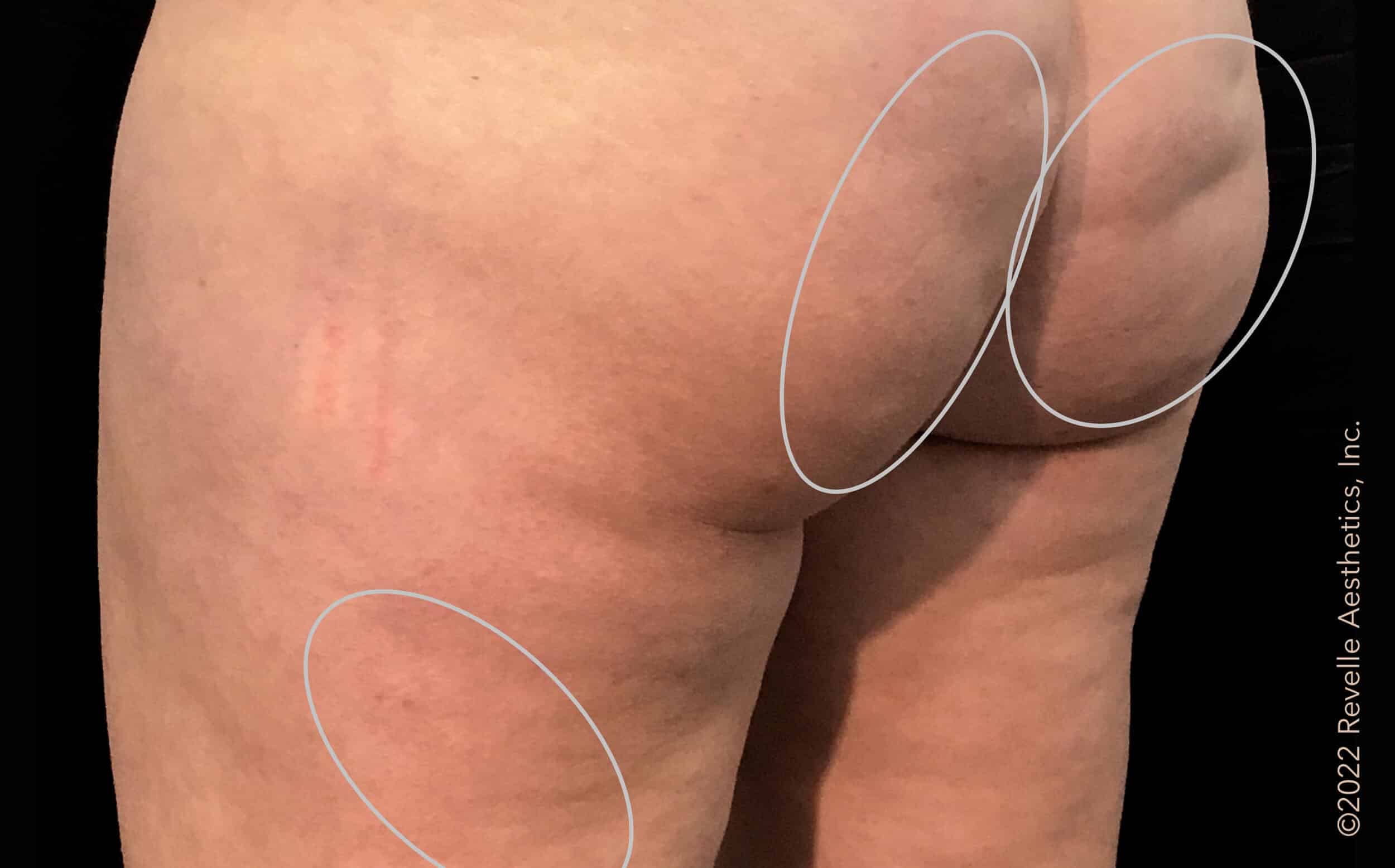 Before Cellulite Treatment Williamsville NY