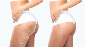 Upper thighs and buttocks with cellulite, cellulite treatment, Williamsville, NY