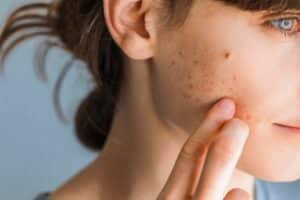Closeup of adult woman with severe acne breakout on her cheek