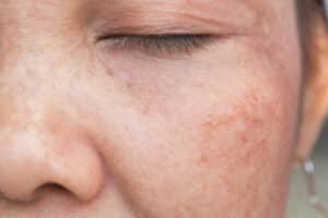 Closeup of woman's face with sun spots to be treated with Cryoclear