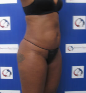 After Image: Liposculpture