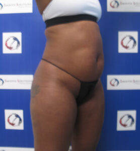 Before Image: Liposculpture