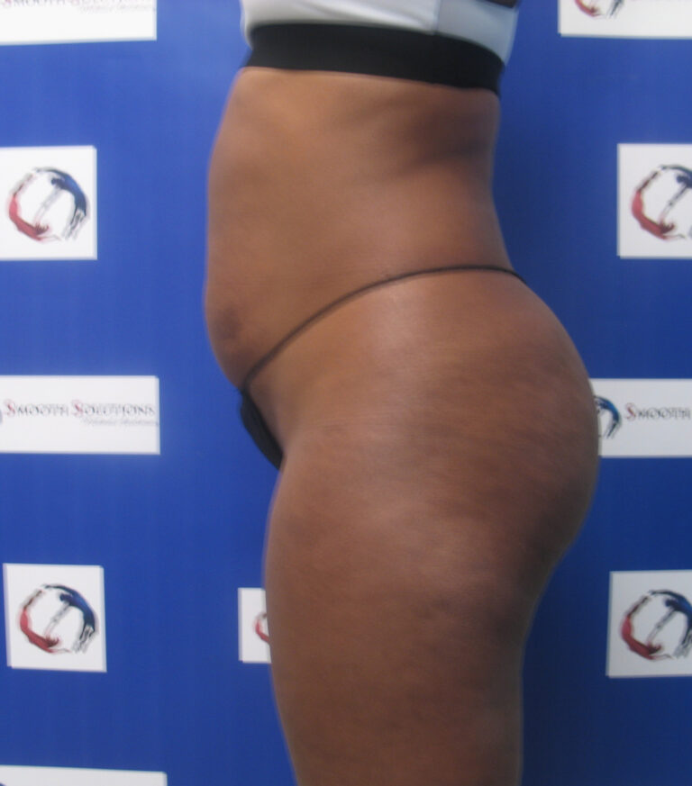 Before Image: Liposculpture - left-side