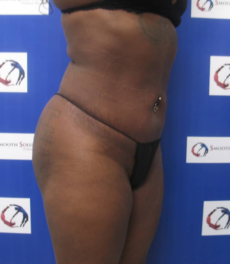 After Image: Liposculpture and Fat Transfer to Buttocks - right-front-oblique